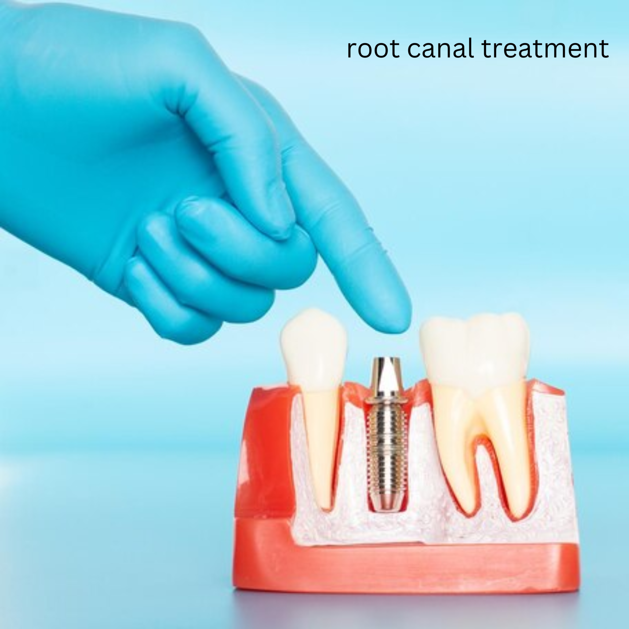Root Canal Treatment