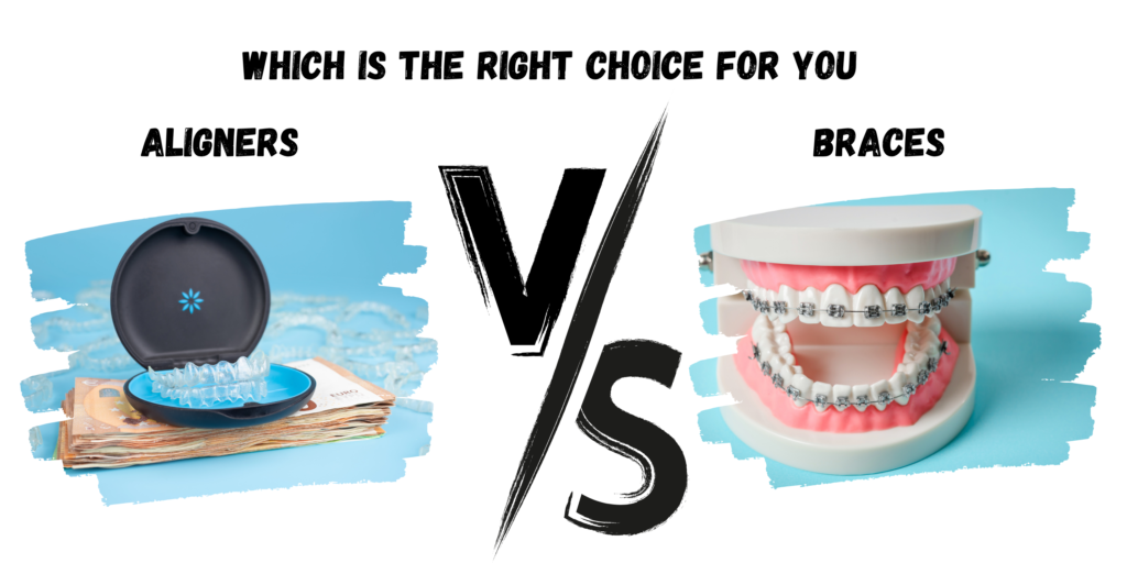 Aligners vs Braces